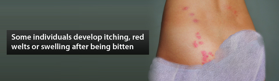 Some individuals develop itching, red welts or swelling after being bitten.